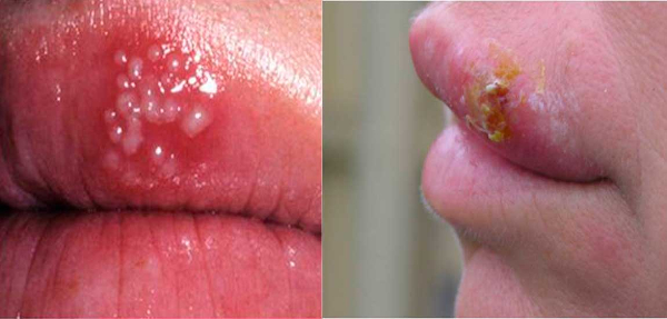 Herpes labial