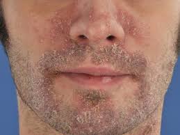 dermatitis barba