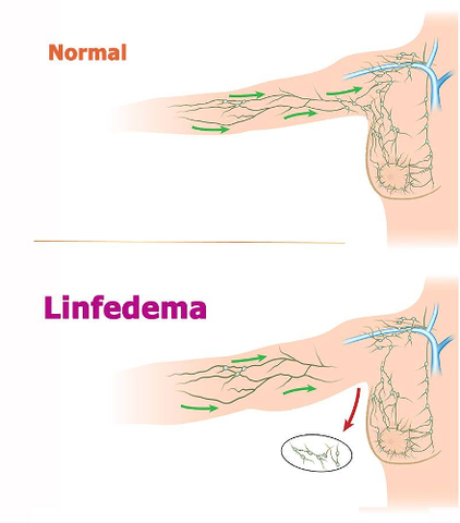 linfedema cancer de mama