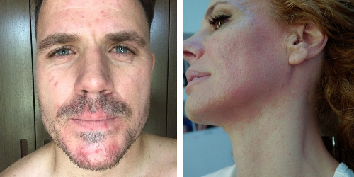 rosacea facial